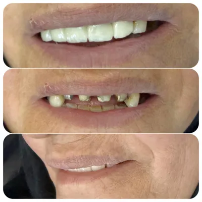 ایمپلنت دیجیتال 