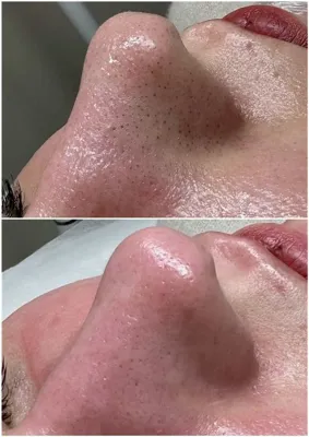 پلاژن تراپی