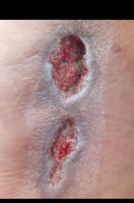 کلینیک زخم در اصفهان