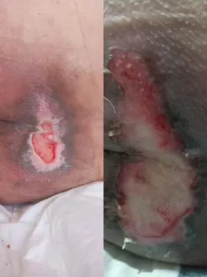 کلینیک زخم در اصفهان