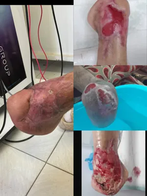 کلینیک زخم در اصفهان