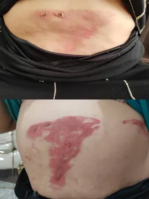 بهترین کلینیک زخم در اصفهان