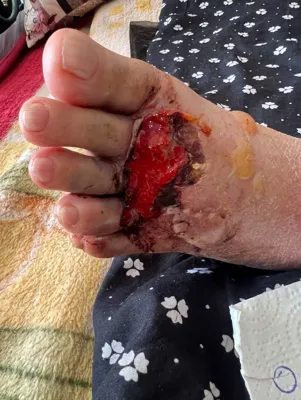 کلینیک زخم در اصفهان