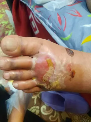 کلینیک زخم در اصفهان