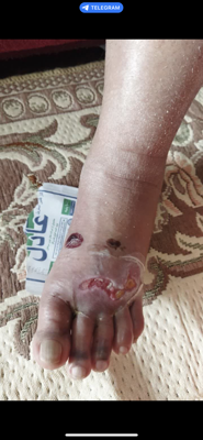 کلینیک زخم در اصفهان