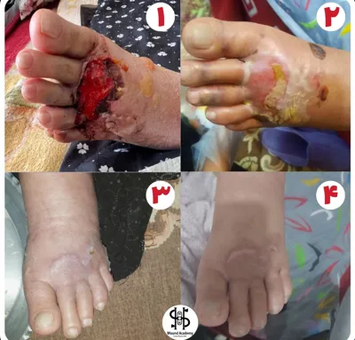 کلینیک زخم در اصفهان