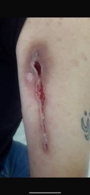 کلینیک زخم در اصفهان