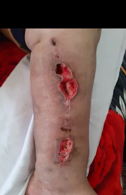 کلینیک زخم در اصفهان