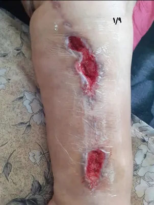 کلینیک زخم در اصفهان