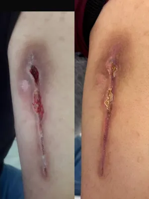 درمان زخم بستر در اصفهان تخصصی