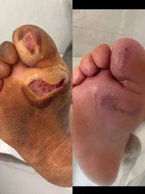 درمان زخم بستر در اصفهان