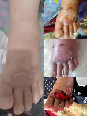 کلینیک زخم بستر در اصفهان