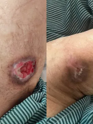 درمان زخم بستر