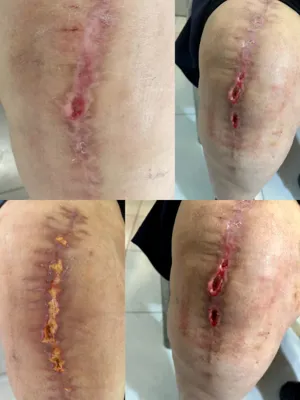 درمان زخم بستر در اصفهان