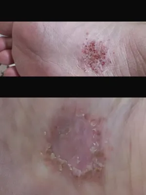 درمان زخم بستر در اصفهان با متخصصان