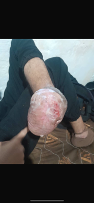 درمان زخم بستر در اصفهان