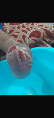 کلینیک درمان زخم بستر