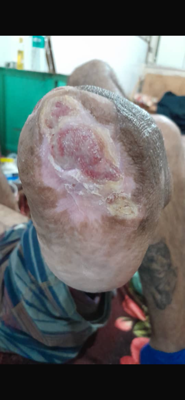 درمان زخم بستر در اصفهان