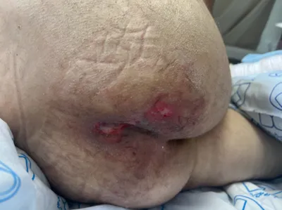 مراقبت و درمان زخم بستر در اصفهان