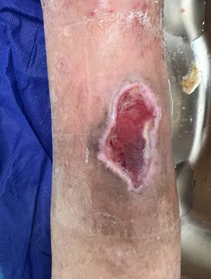 درمان زخم بستر در اصفهان