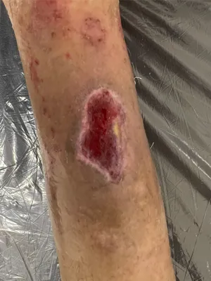 مرکز درمان زخم بستر در اصفهان