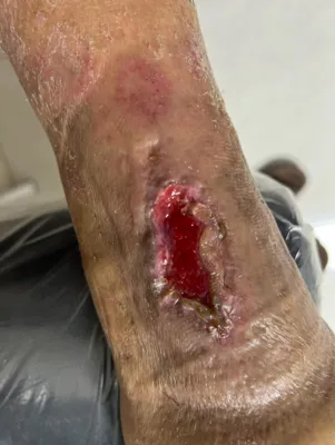 درمان زخم بستر