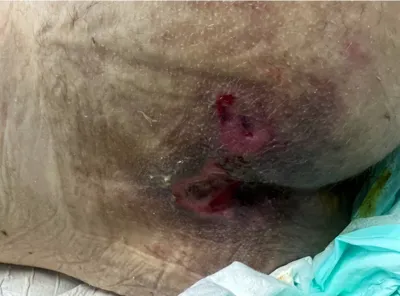 درمان زخم بستر در اصفهان