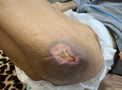 کارشناس درمان زخم بستر در اصفهان