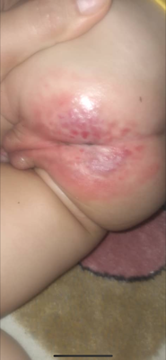 زخم بستر در اصفهان