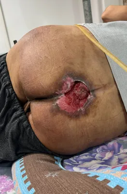 درمان زخم بستر در اصفهان