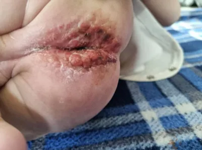 درمان زخم بستر