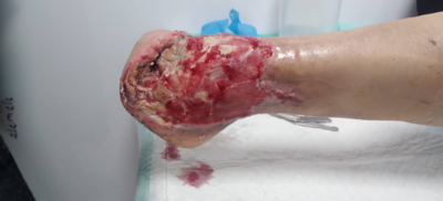 درمان زخم بستر در اصفهان