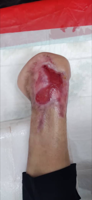 درمان زخم بستر در اصفهان