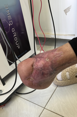 درمان زخم بستر در اصفهان