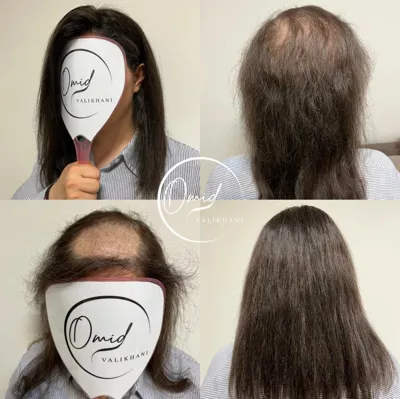 ترمیم مو در فولادشهر