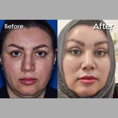 دکتر جراحی بینی در تهران