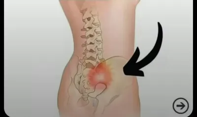 دیسک وسیاتیک بدون عمل جراحی