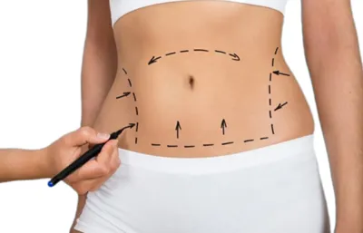 لیپوساکشن در زاهدان