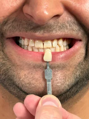 بهترین دندانپزشک زیبایی شیراز