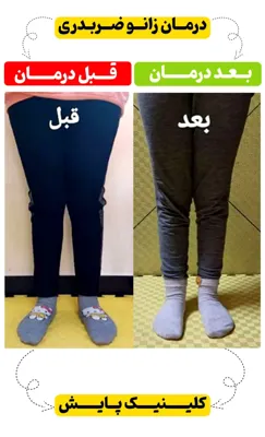 درمان زانو ضربدری