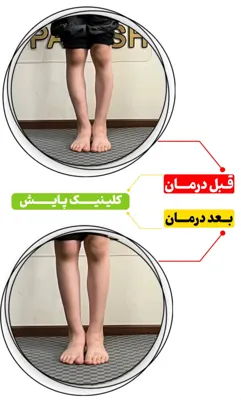 قبل و بعد از درمان