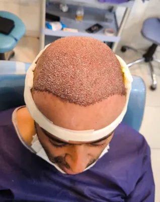 کاشت مو تضمینی در شیراز