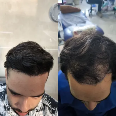 کاشت مو تضمینی در شیراز