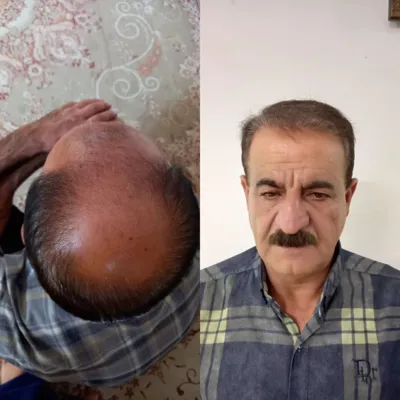 کاشت مو تضمینی در شیراز