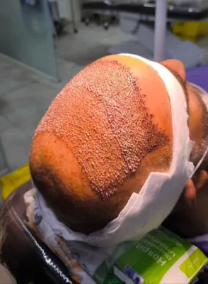 کاشت مو تضمینی در شیراز