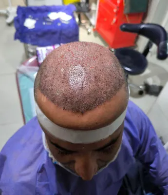 کاشت مو تضمینی در شیراز