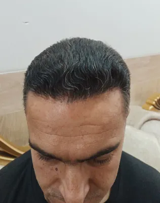 کاشت مو تضمینی در شیراز