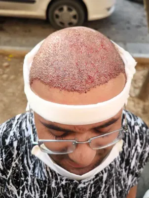 کاشت مو تضمینی در شیراز