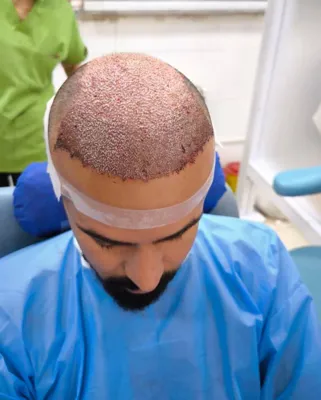 کاشت مو تضمینی در شیراز