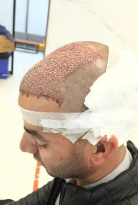 کاشت مو تضمینی در شیراز